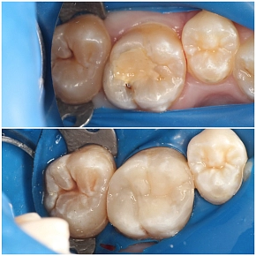 Клинический случай лечения глубокого кариеса