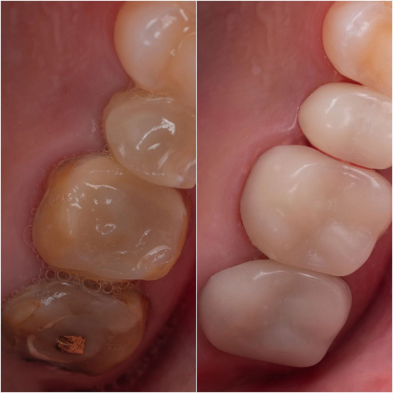 3D-напечатанные временные коронки