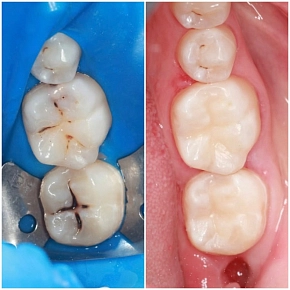 Миниинвазивное лечение кариеса: забота о ваших зубах!