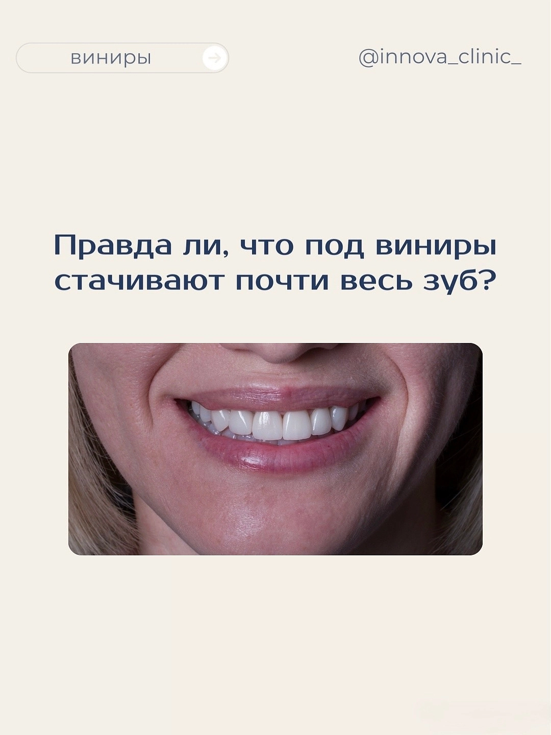 Идеальная улыбка с винирами