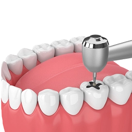 Лечение зубов у детей фото