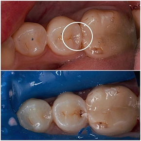 Загадка под пломбой