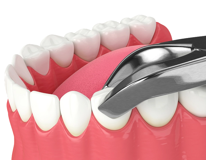 Удаление зубов фото