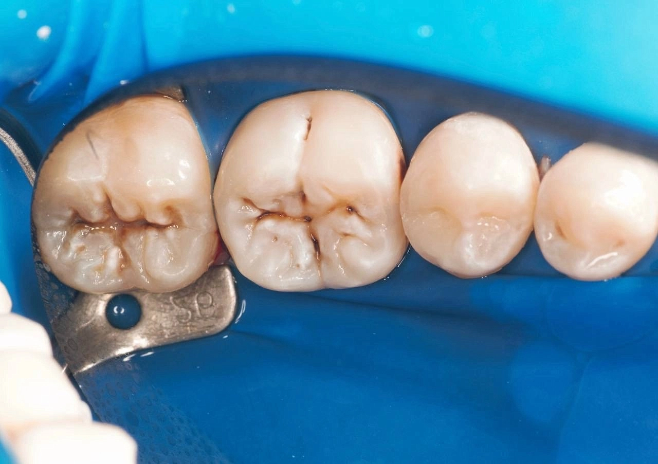 Зубосохраняющая реставрация