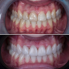 Важный шаг перед установкой виниров