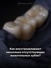 Как восстанавливают несколько отсутствующих жевательных зубов?