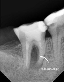 Восстановление костной структуры зуба
