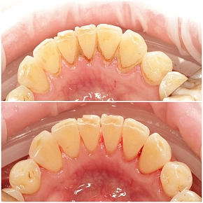 Можно ли восстановить зубы кальцием с помощью еды и витаминов