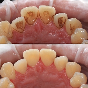 Профессиональная гигиена полости рта