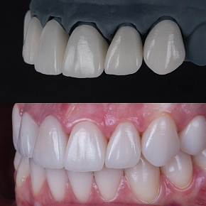 Преимущества керамических коронок и виниров