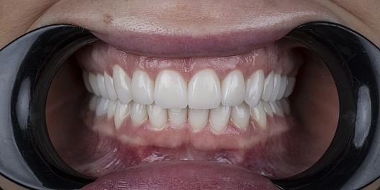После