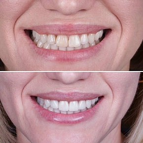 Как подбирается форма будущих виниров?