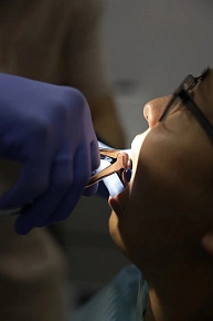 Сложное удаление зуба