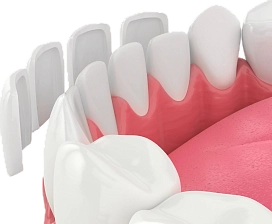 Виниры фото