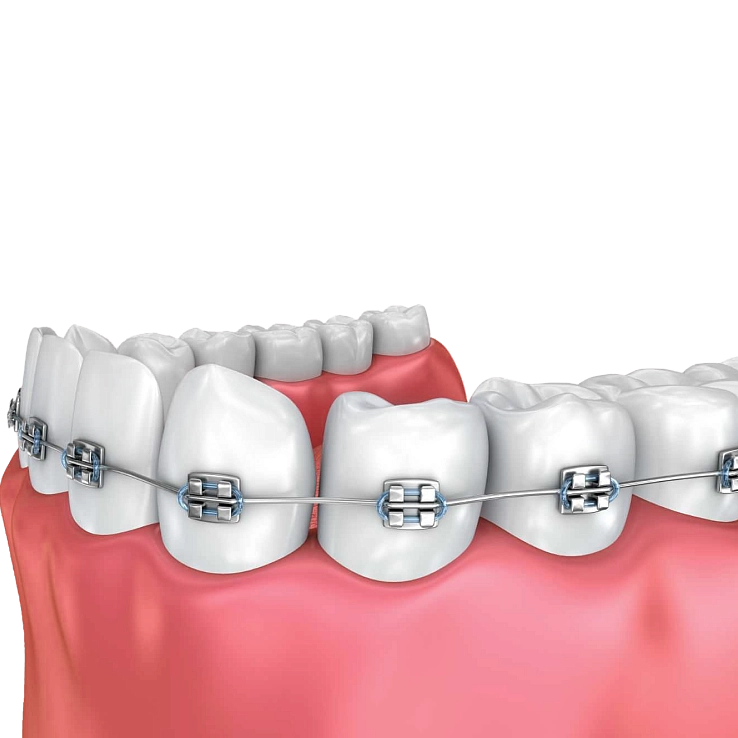 Установка брекетов фото