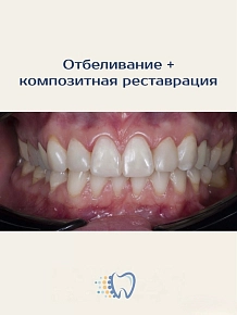 Потемневшие зубы, сколы или неровный край можно аккуратно и естественно исправить
