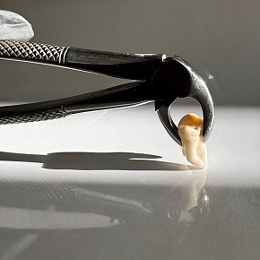 Можно ли удалить все зубы мудрости одновременно?