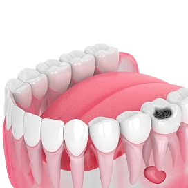 Лечение пульпита фото