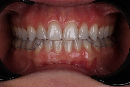 Стискивание и скрежетание зубов: это нормально?